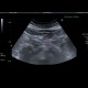Chronic pancreatitis: US - Ultrasound
